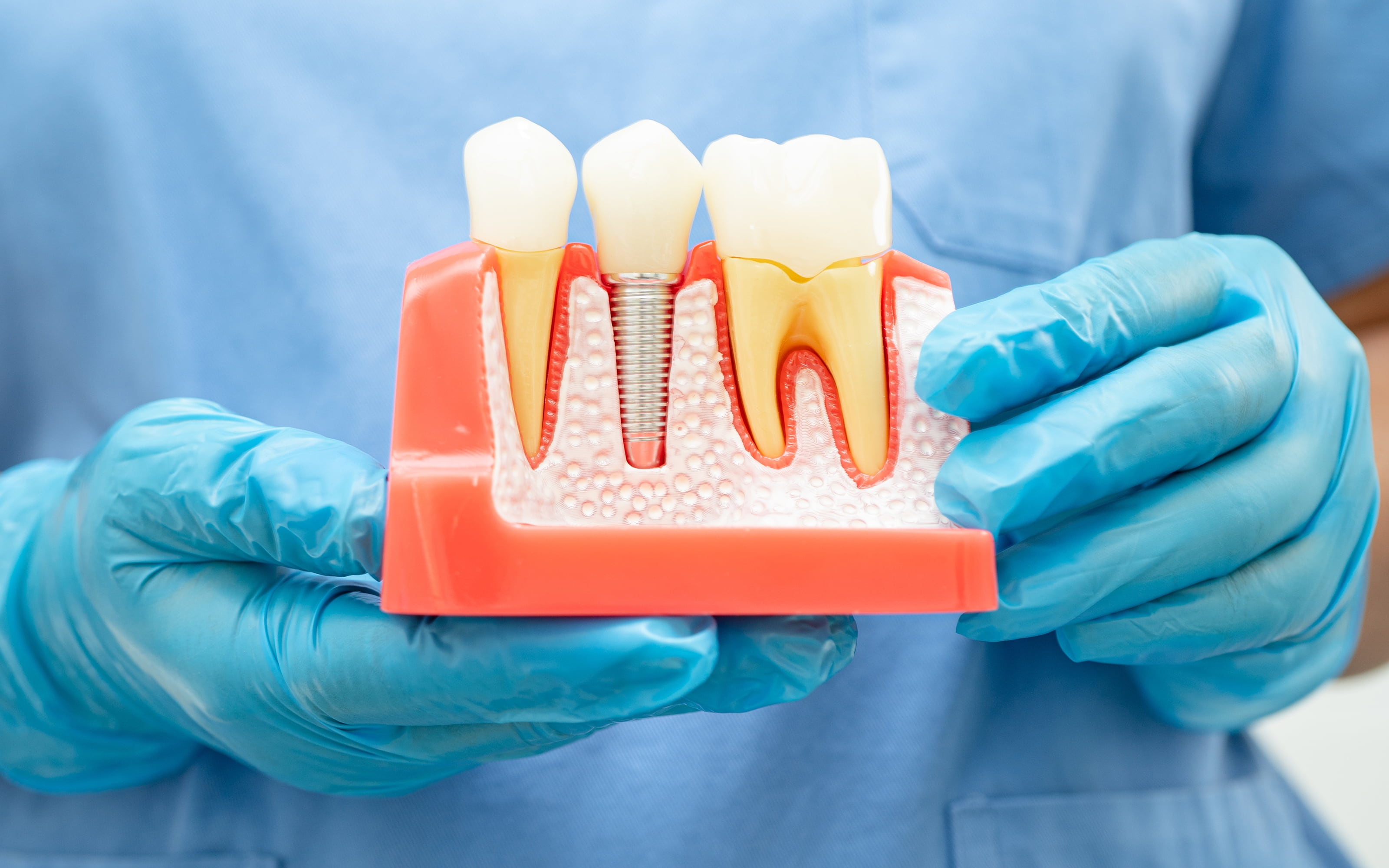 What are dental implants