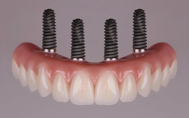 Teeth in a Day — happy smiling patient
