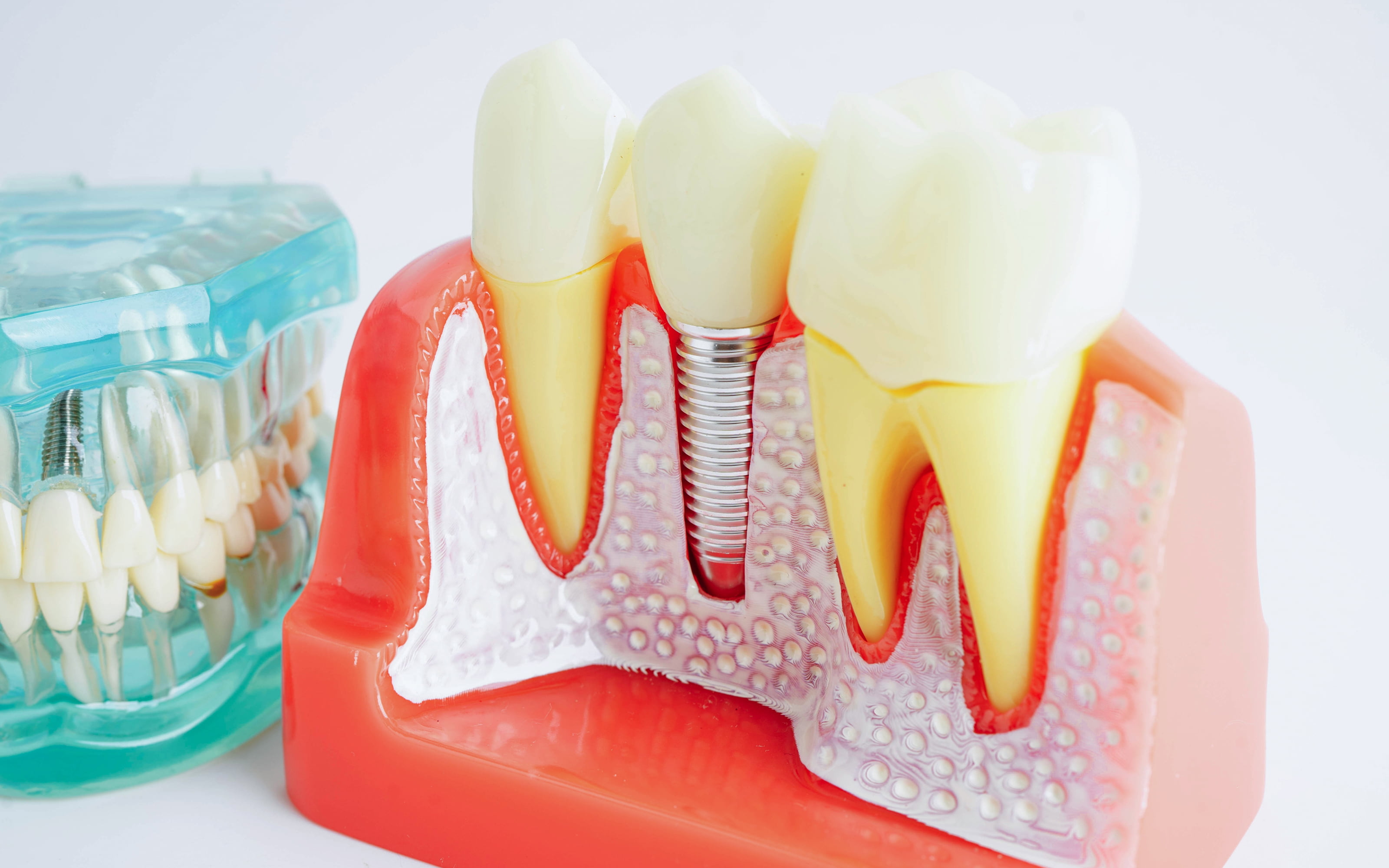 Multiple dental implants